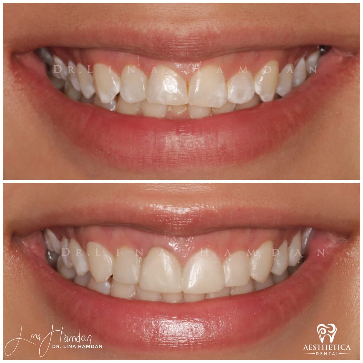 Composite bonding. — anonymous patient at Aesthetica Dental Naperville