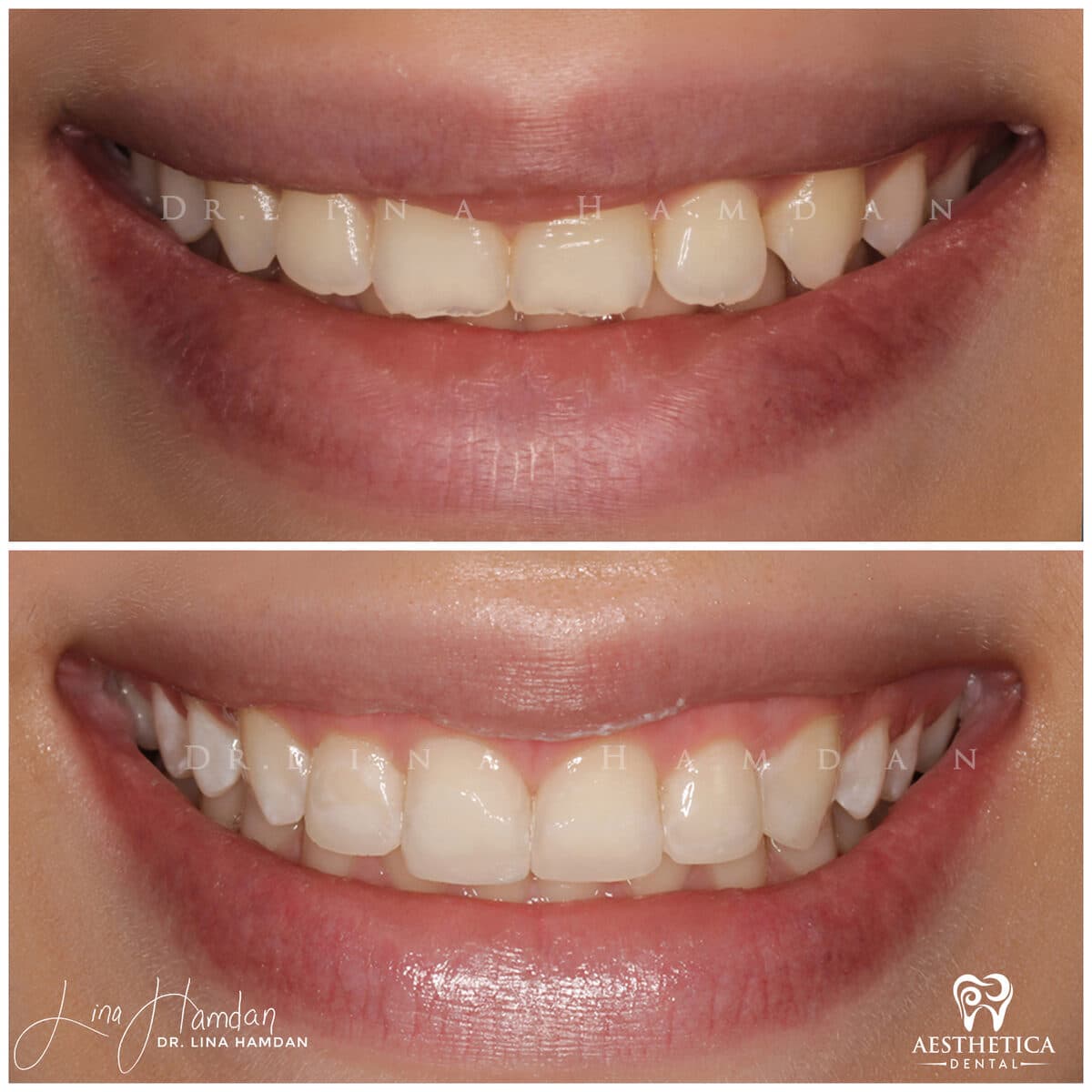 Composite bonding result, anonymous patient at Aesthetica Dental Naperville (case 2, 2025-01-1-44)