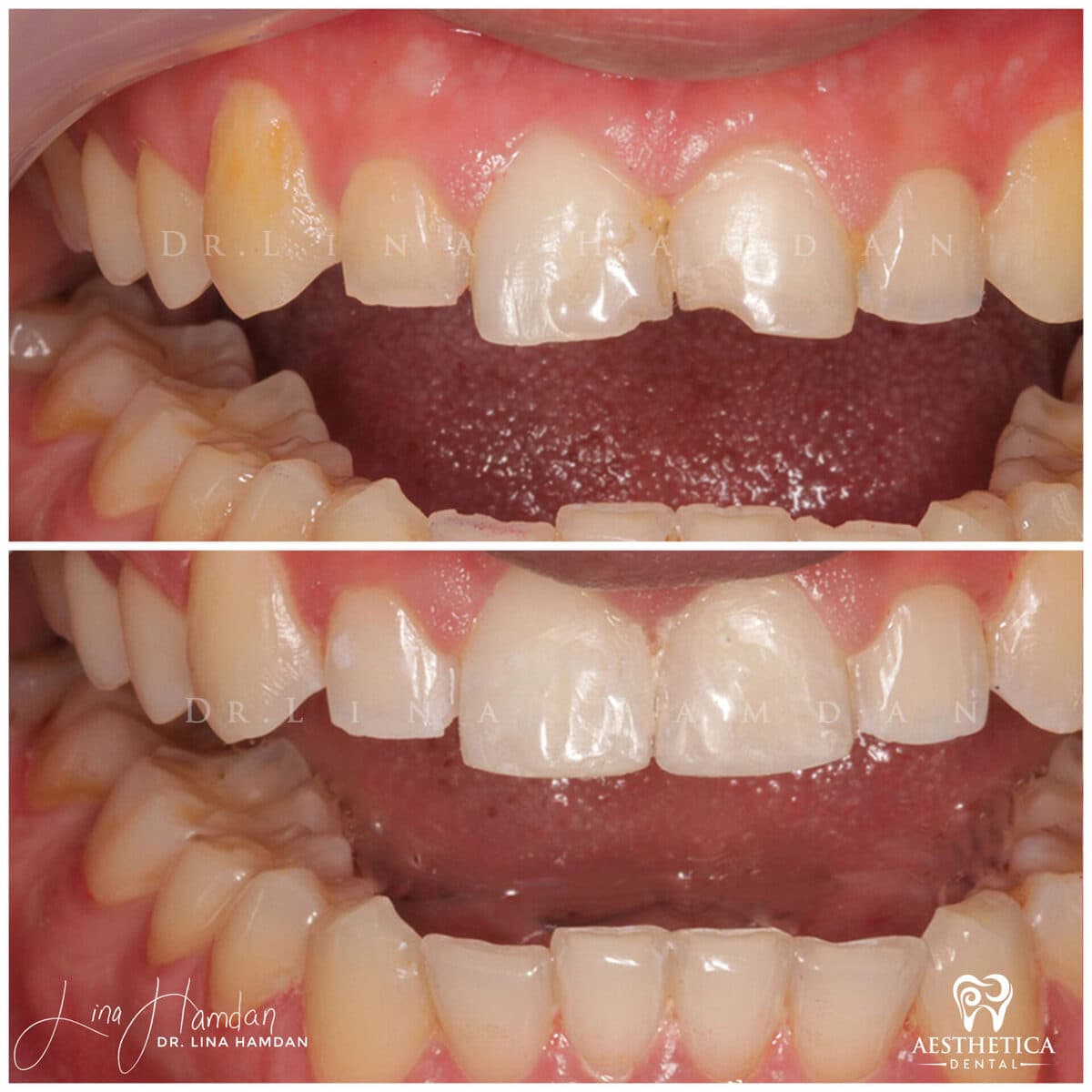 Composite bonding result, anonymous patient at Aesthetica Dental Naperville (case 8, 2025-01-1-50)