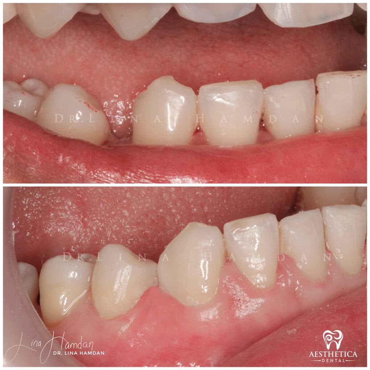 Composite bonding result, anonymous patient at Aesthetica Dental Naperville (case 10, 2025-01-1-52)