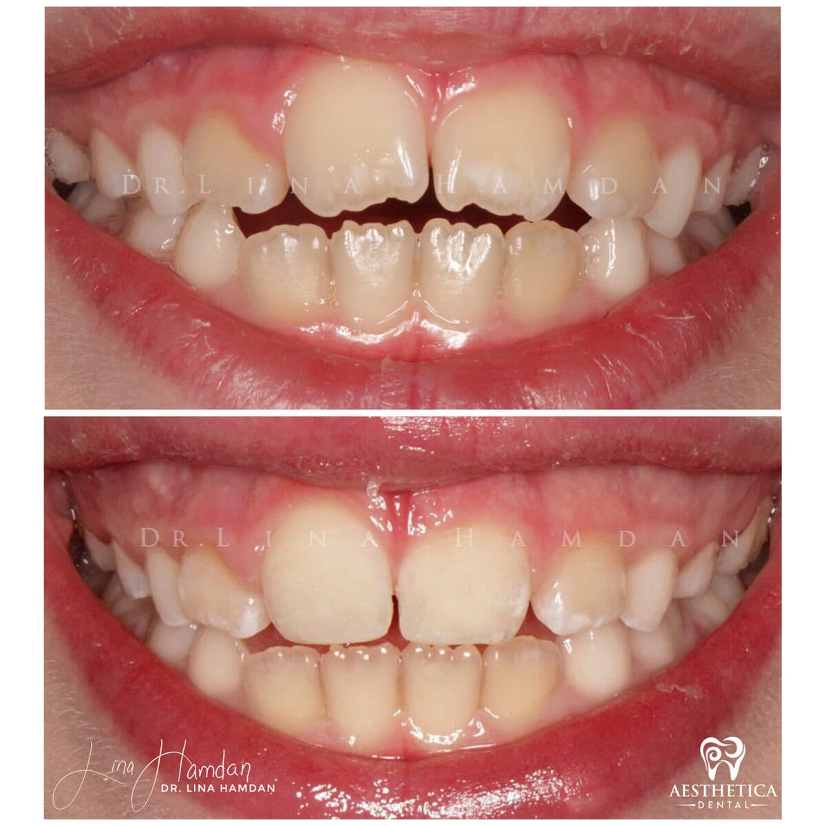Composite bonding: anonymous case 13 from Aesthetica Dental Naperville