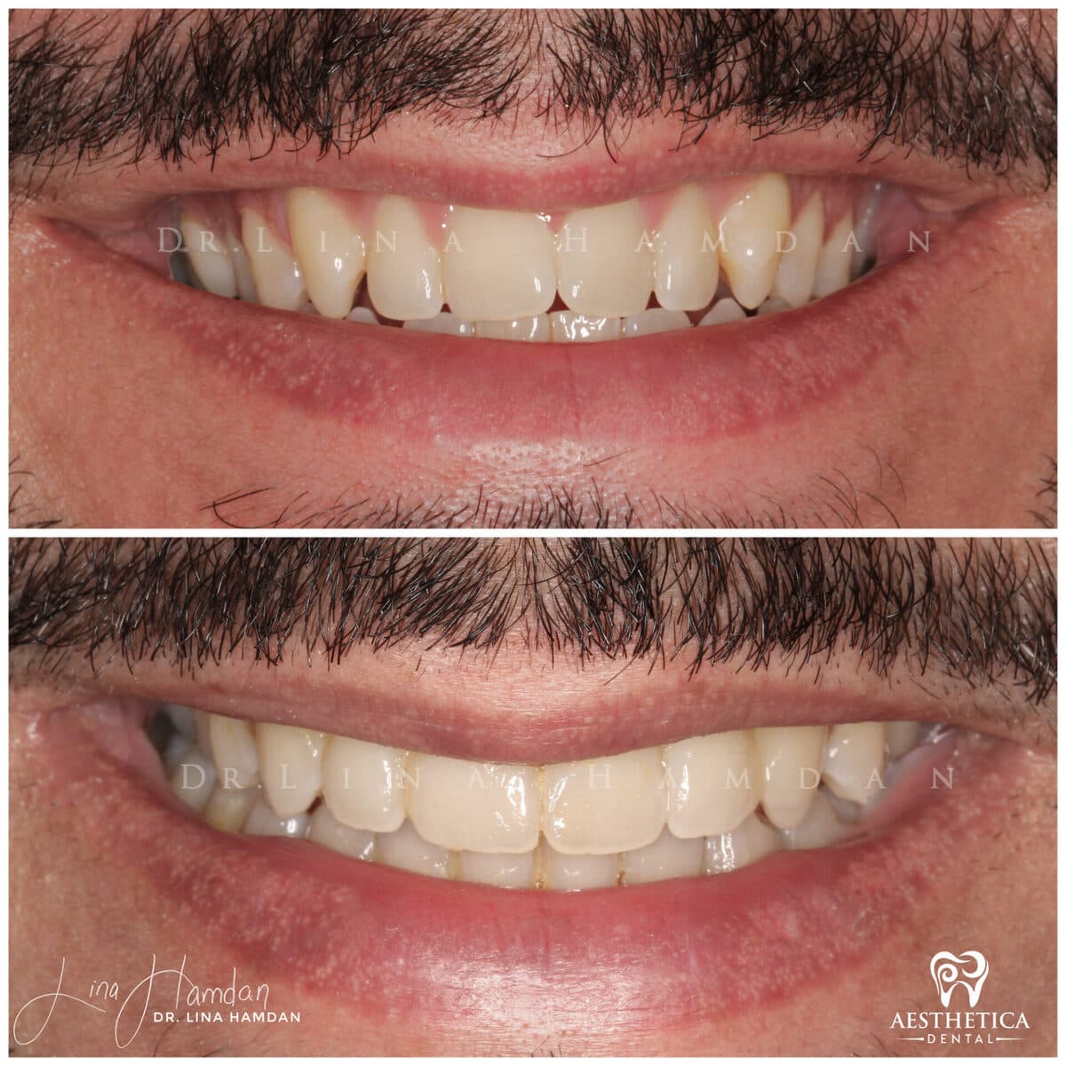 Composite bonding: anonymous case 15 from Aesthetica Dental Naperville