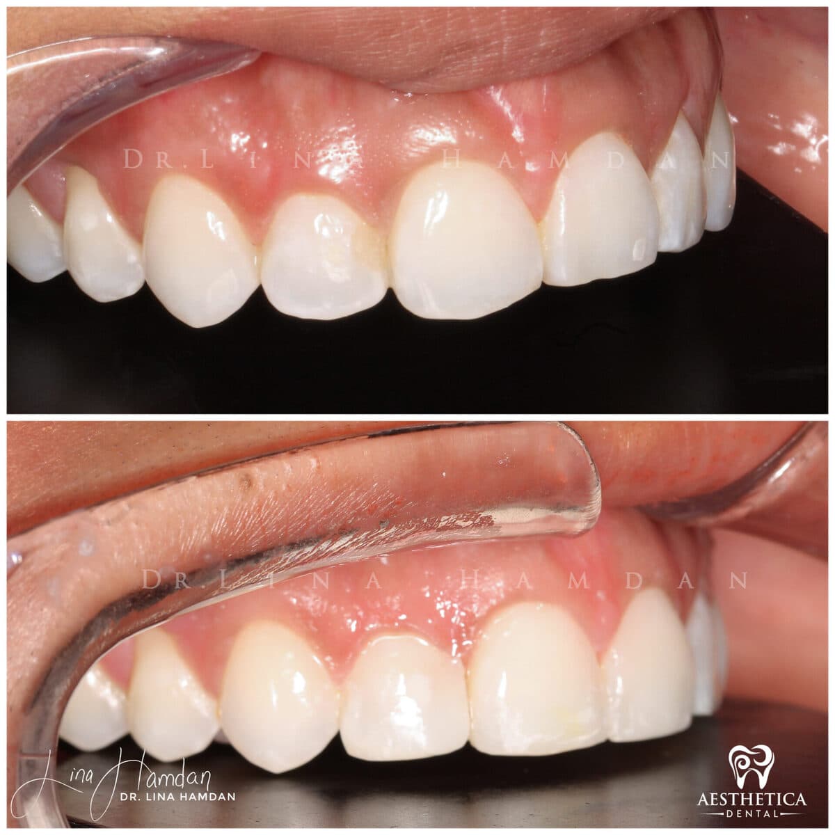 Composite bonding: anonymous case 20 from Aesthetica Dental Naperville