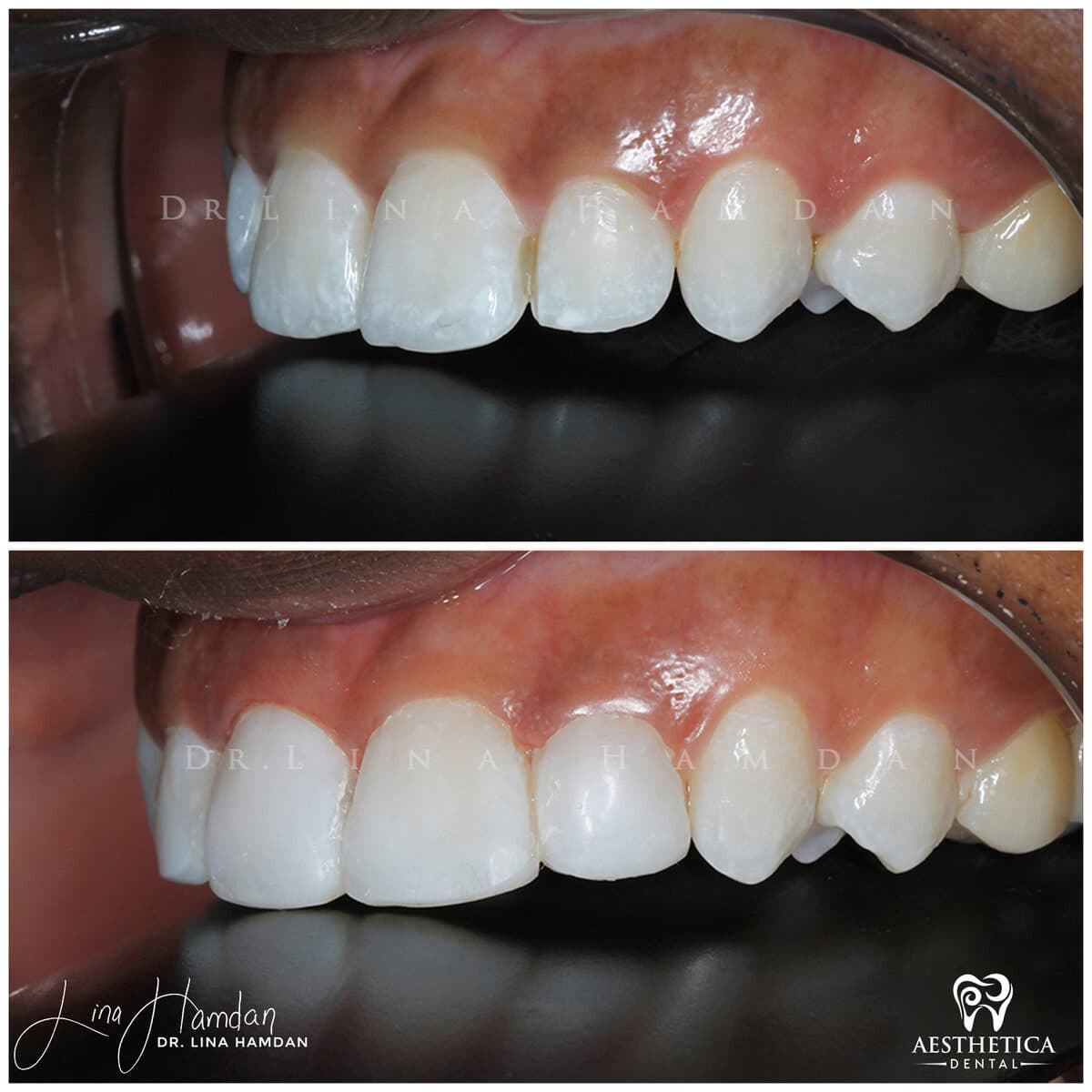 Composite bonding: anonymous case 22 from Aesthetica Dental Naperville