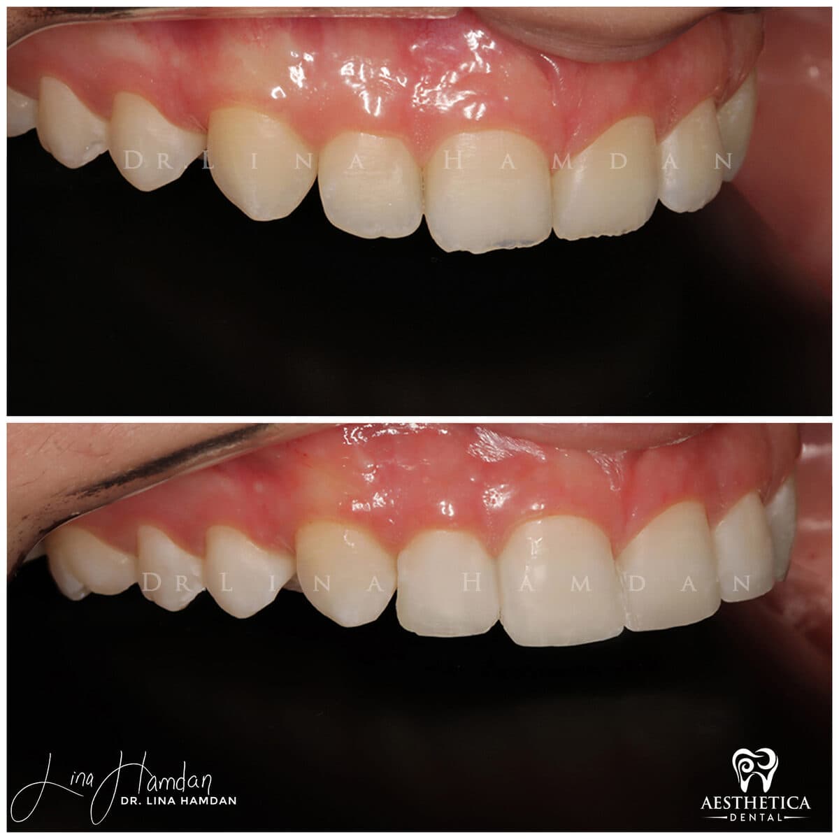 Composite bonding: anonymous case 28 from Aesthetica Dental Naperville