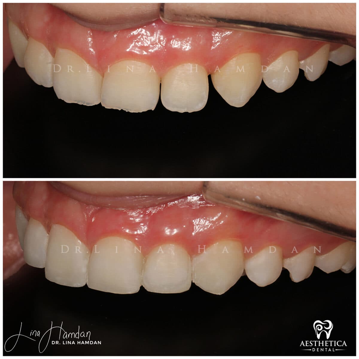 Composite bonding: anonymous case 31 from Aesthetica Dental Naperville