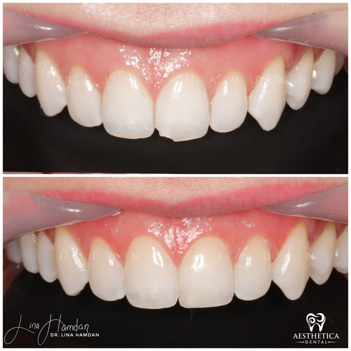 Composite bonding: anonymous case 38 from Aesthetica Dental Naperville