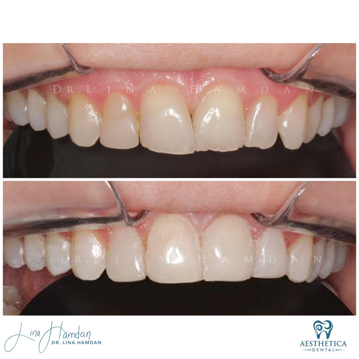 Composite bonding: anonymous case 45 from Aesthetica Dental Naperville