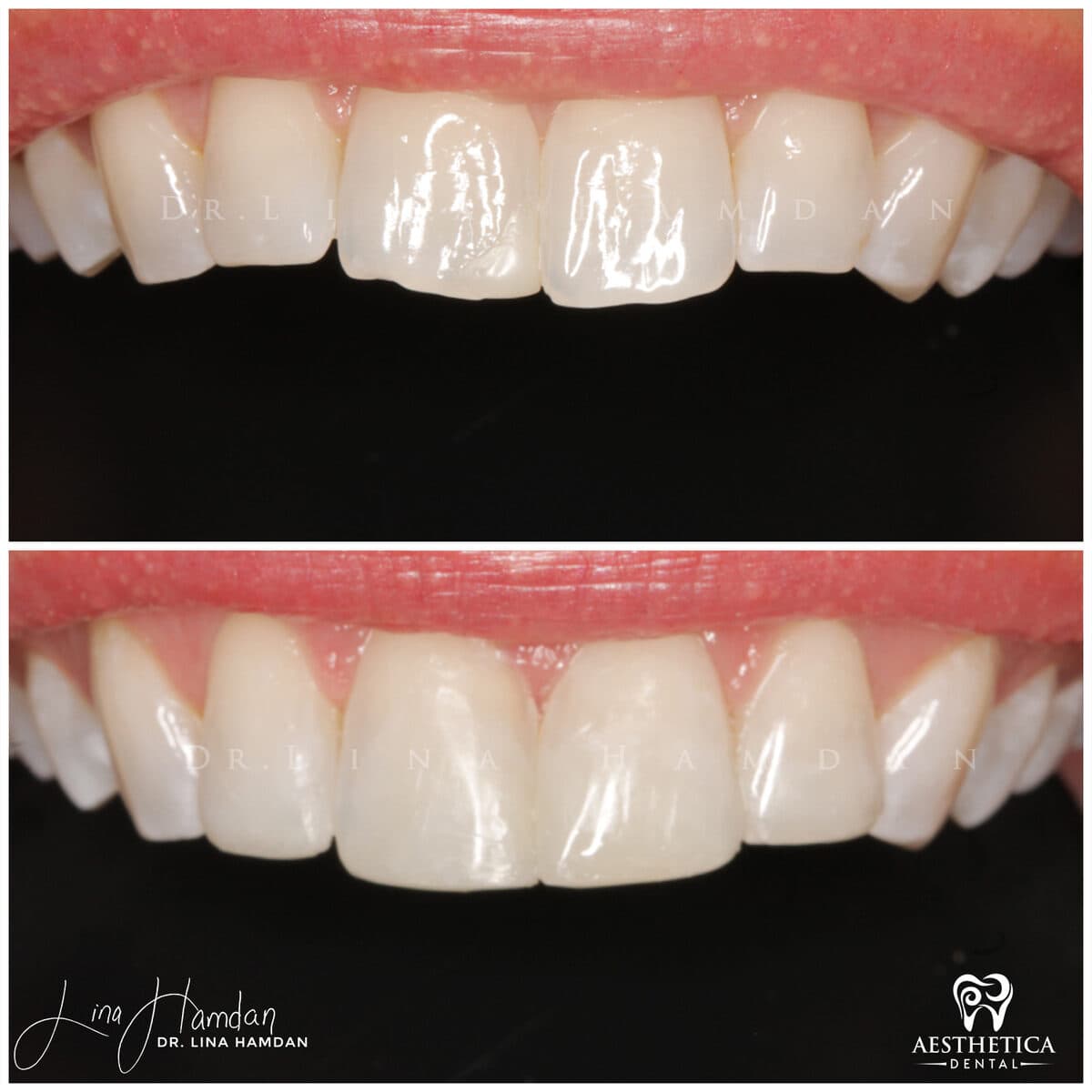 Composite bonding: anonymous case 50 from Aesthetica Dental Naperville