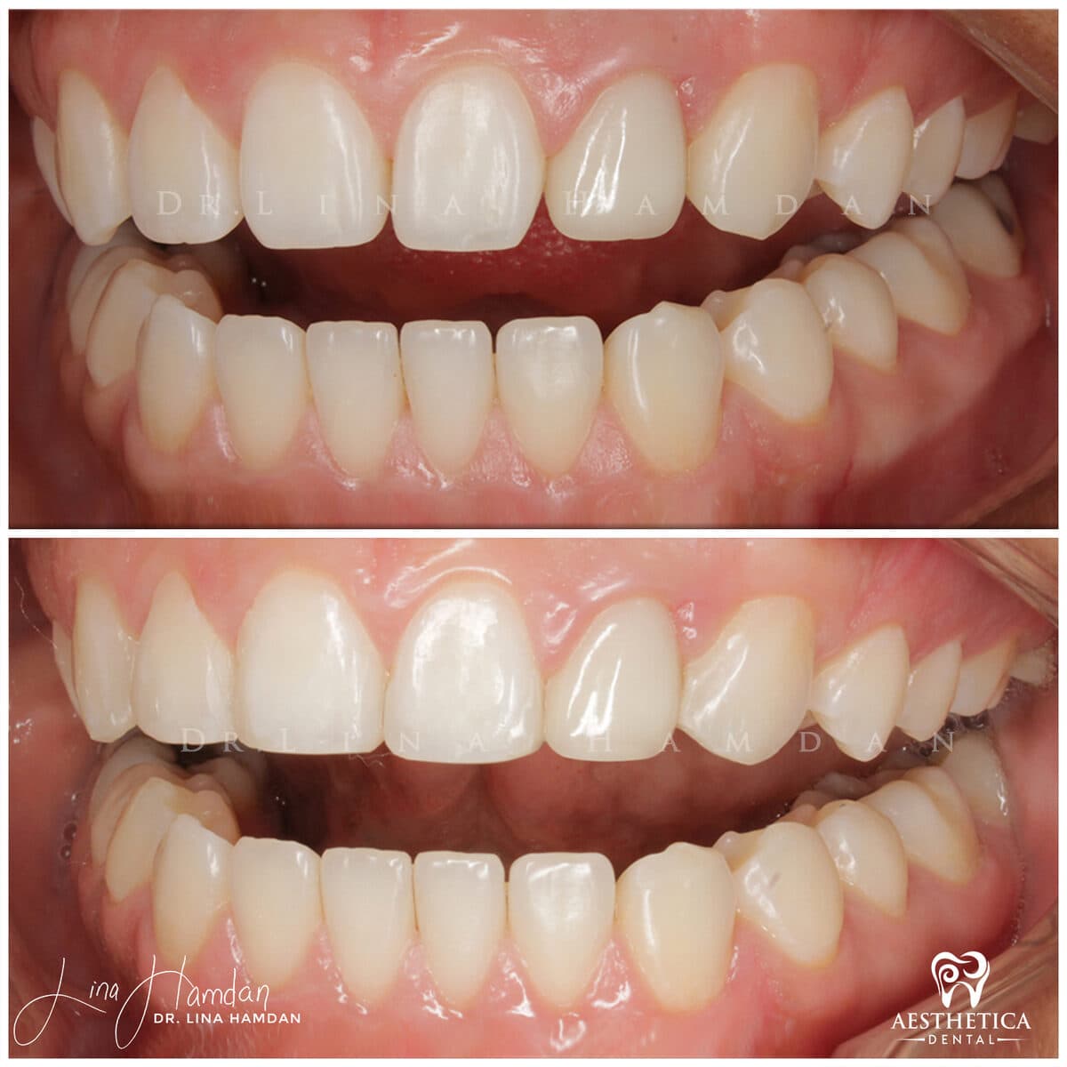 Composite bonding: anonymous case 52 from Aesthetica Dental Naperville