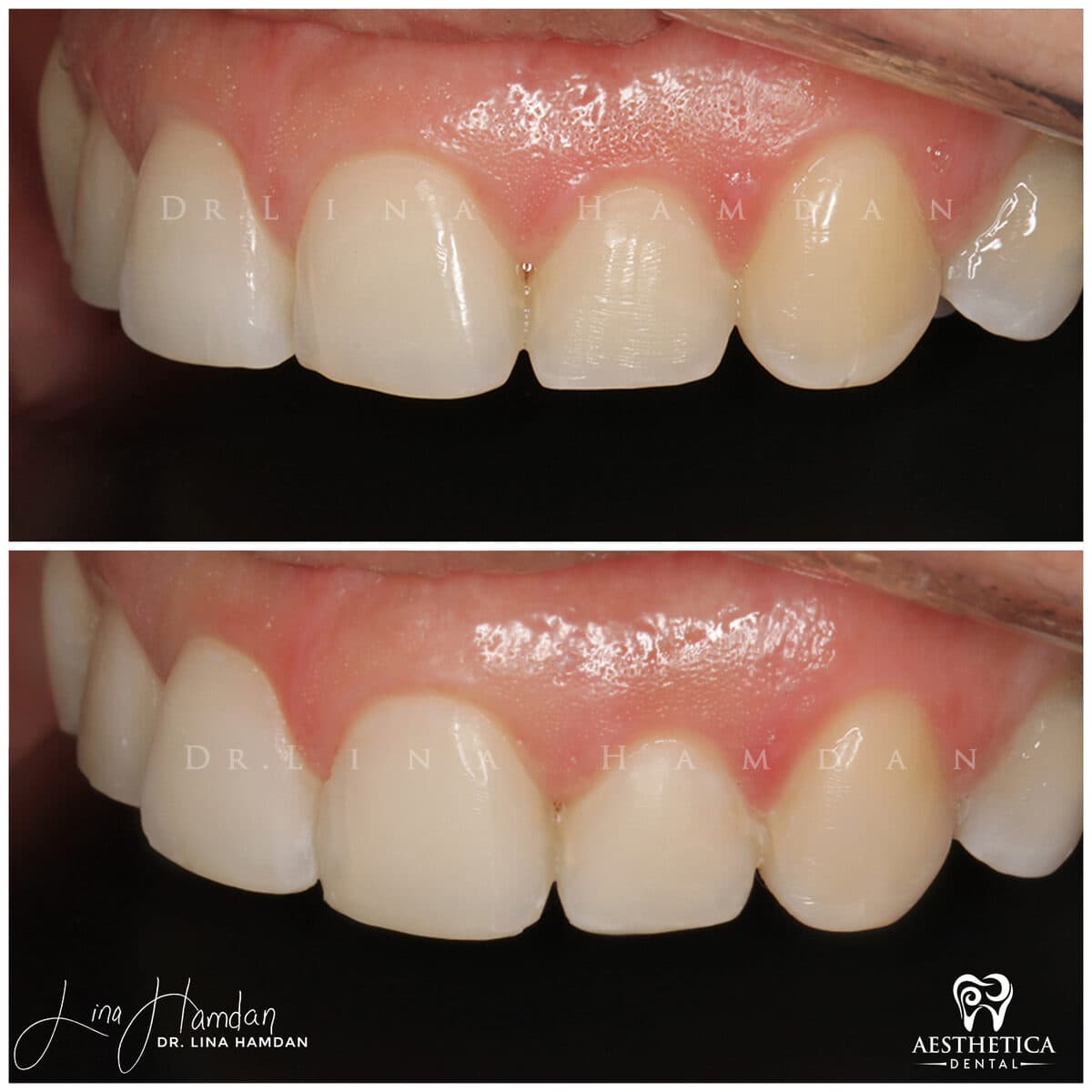 Composite bonding: anonymous case 54 from Aesthetica Dental Naperville
