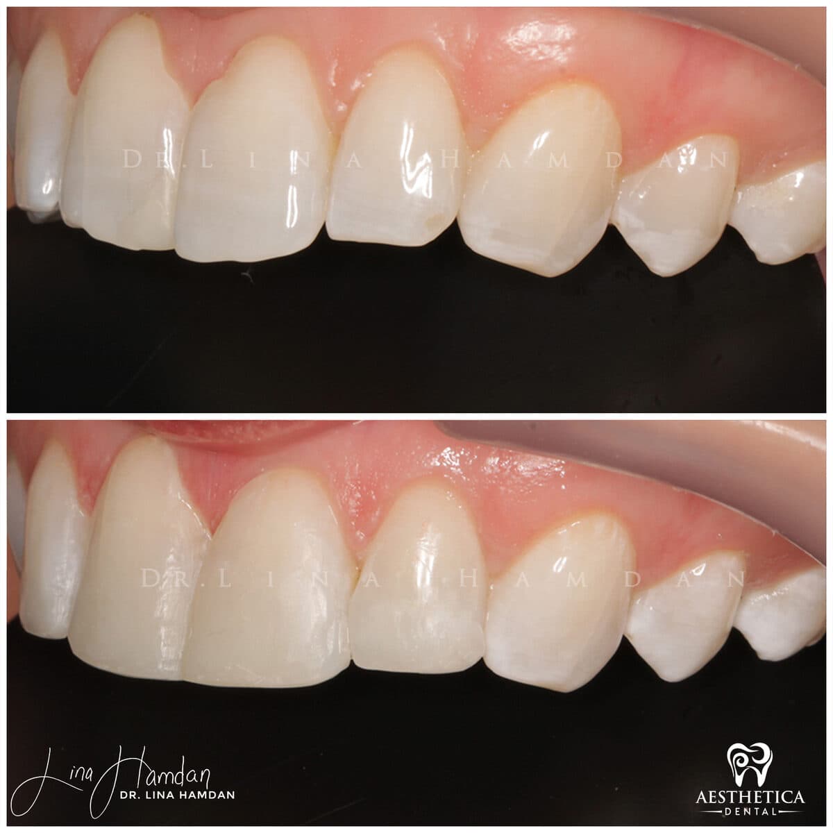 Composite bonding: anonymous case 60 from Aesthetica Dental Naperville