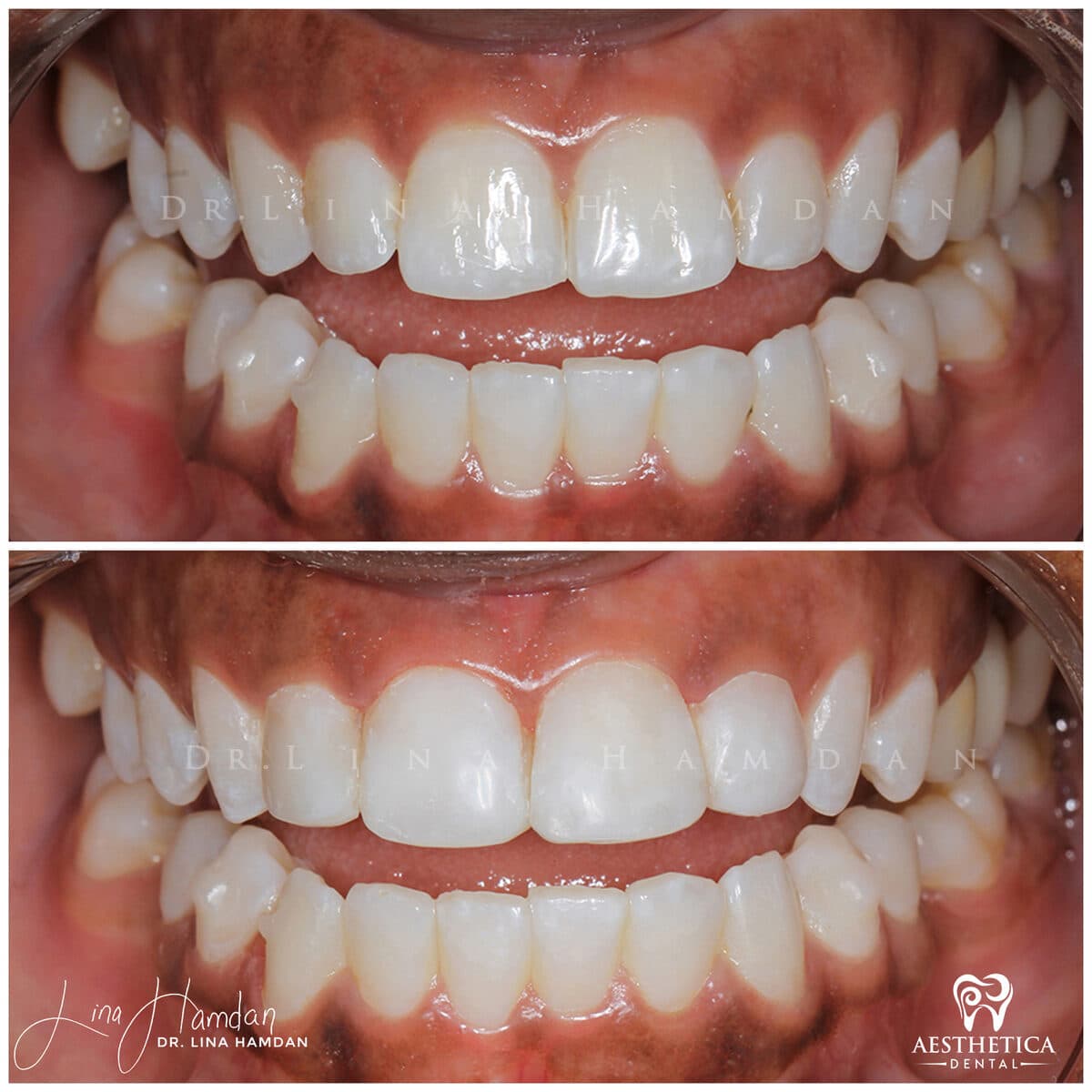Composite bonding: anonymous case 65 from Aesthetica Dental Naperville