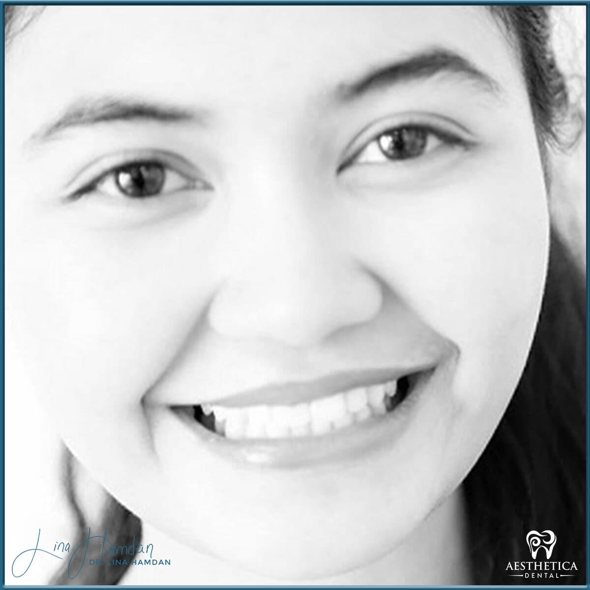 Composite bonding: anonymous case 73 from Aesthetica Dental Naperville
