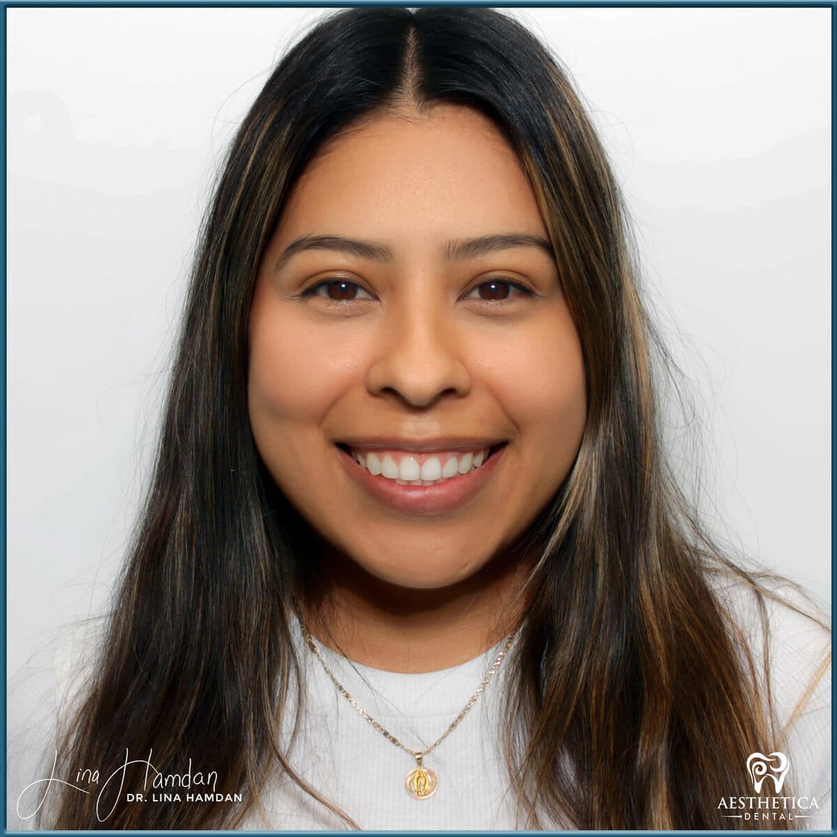Composite bonding: anonymous case 77 from Aesthetica Dental Naperville