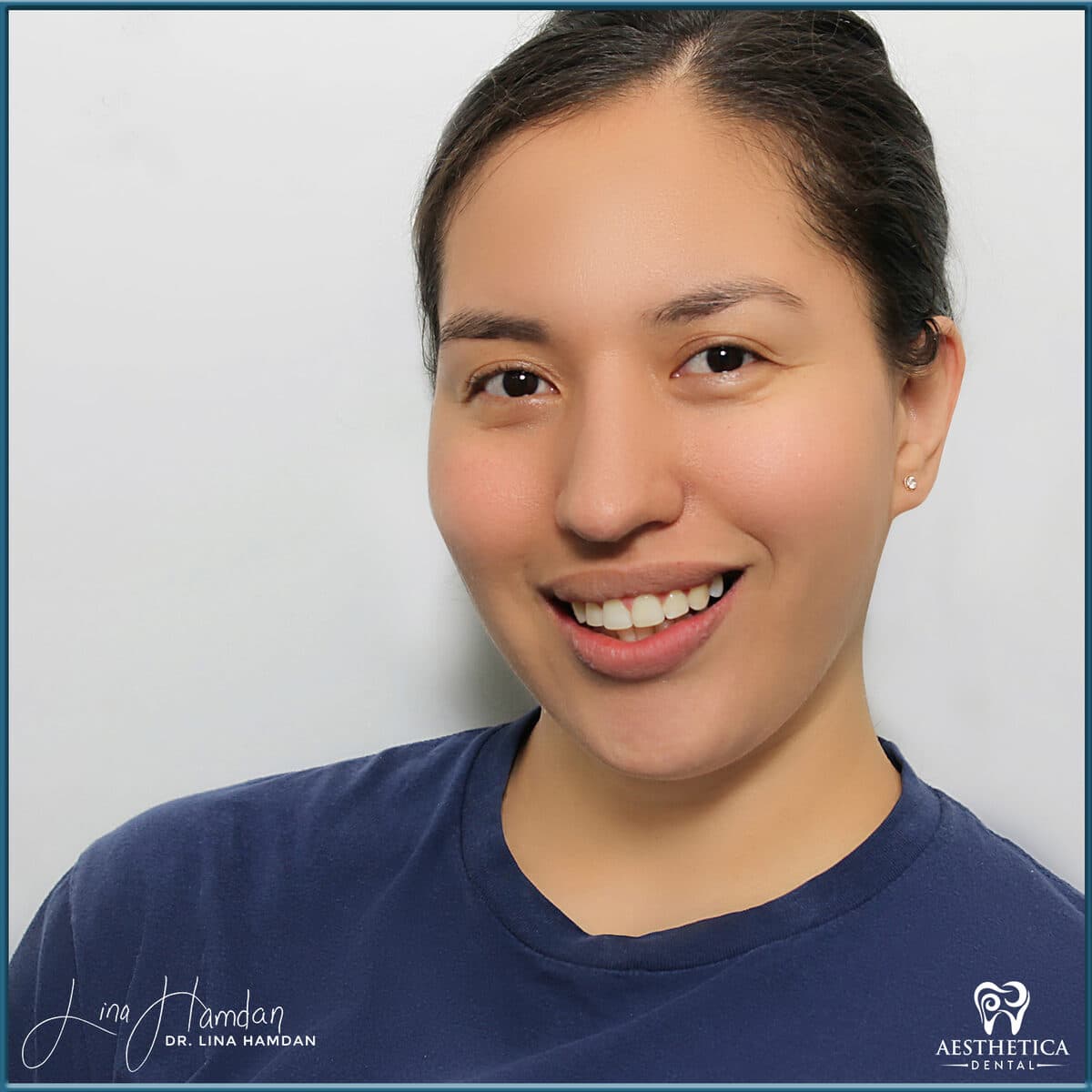 Composite bonding: anonymous case 80 from Aesthetica Dental Naperville