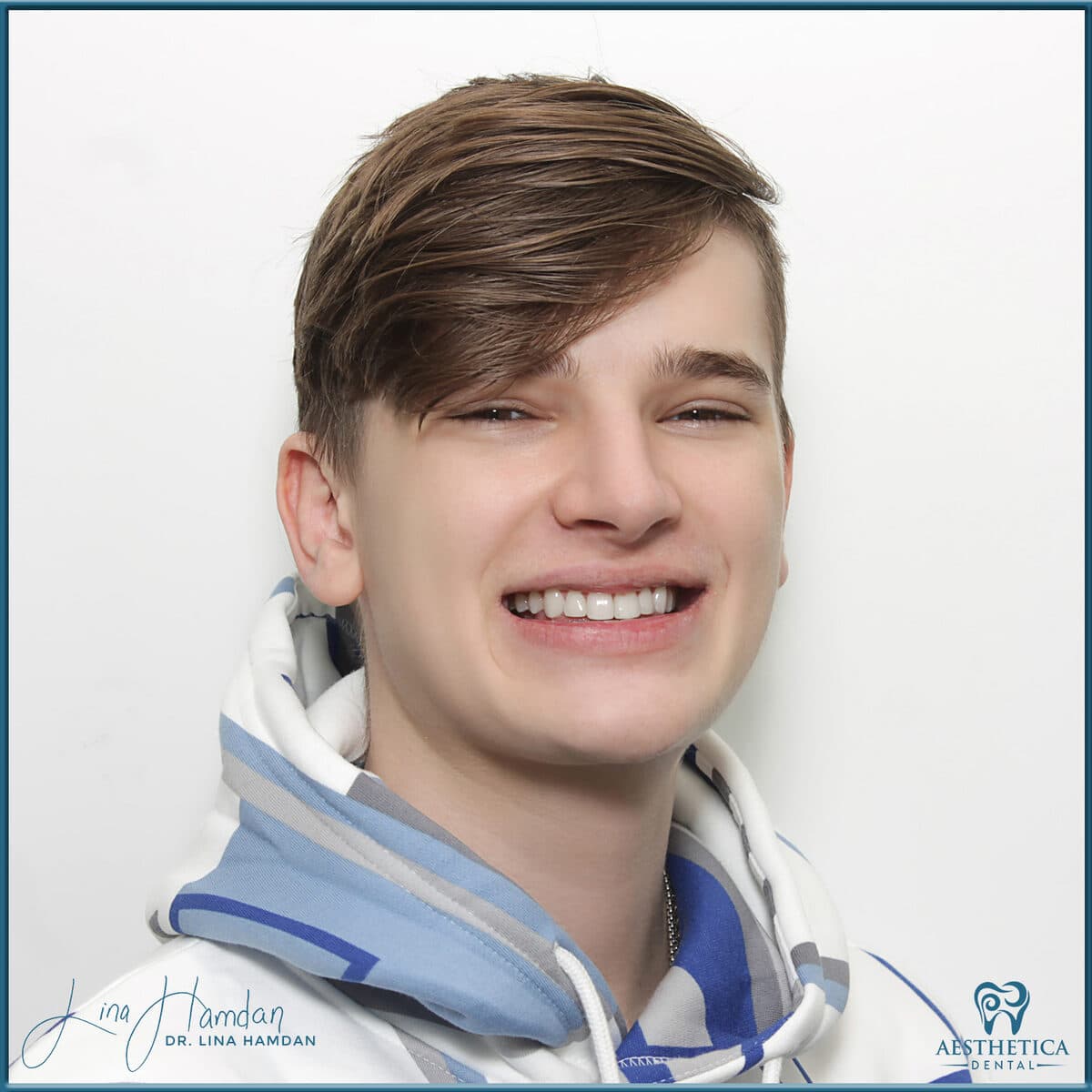 Composite bonding: anonymous case 86 from Aesthetica Dental Naperville