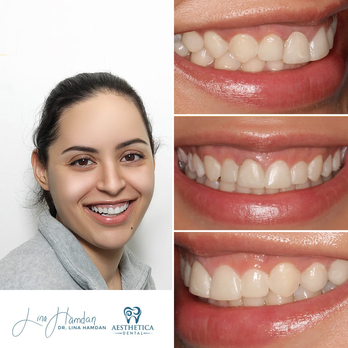 Composite bonding: anonymous case 87 from Aesthetica Dental Naperville