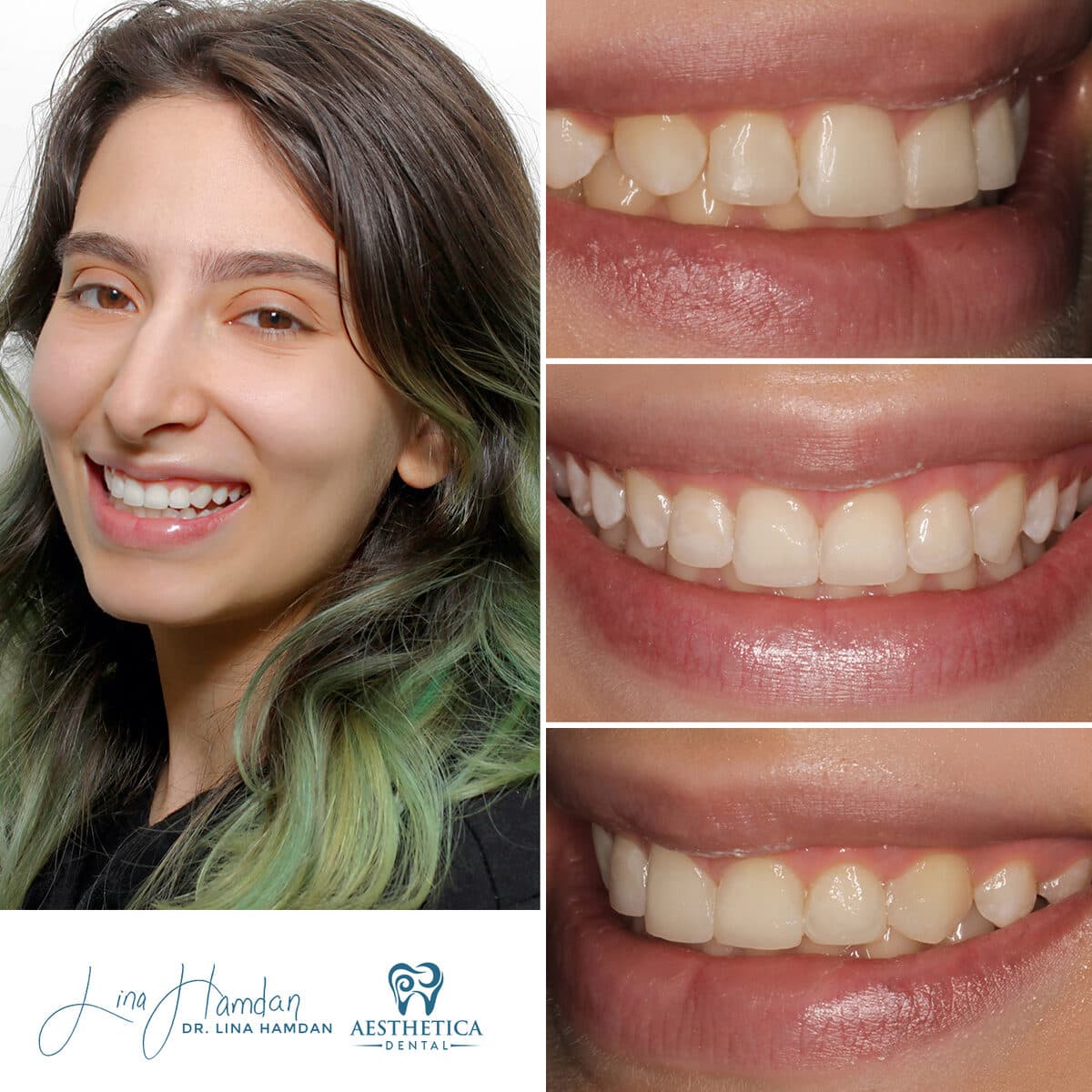 Composite bonding: anonymous case 88 from Aesthetica Dental Naperville