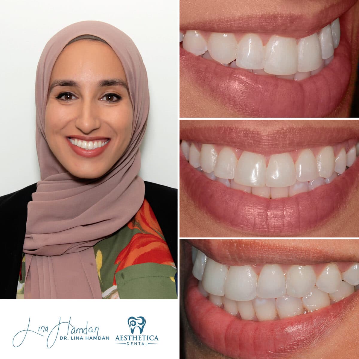 Composite bonding: anonymous case 92 from Aesthetica Dental Naperville