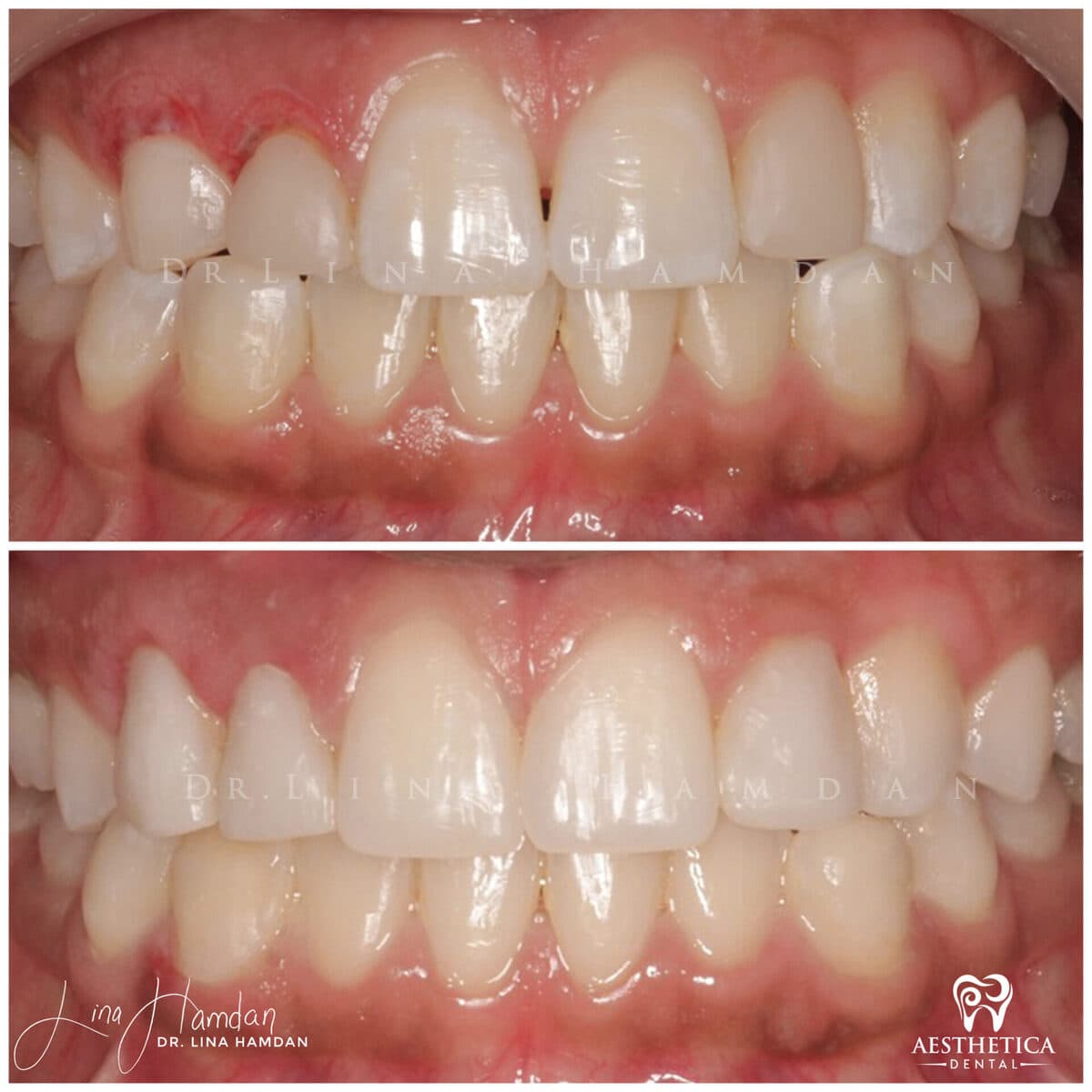 Composite bonding: anonymous case 94 from Aesthetica Dental Naperville