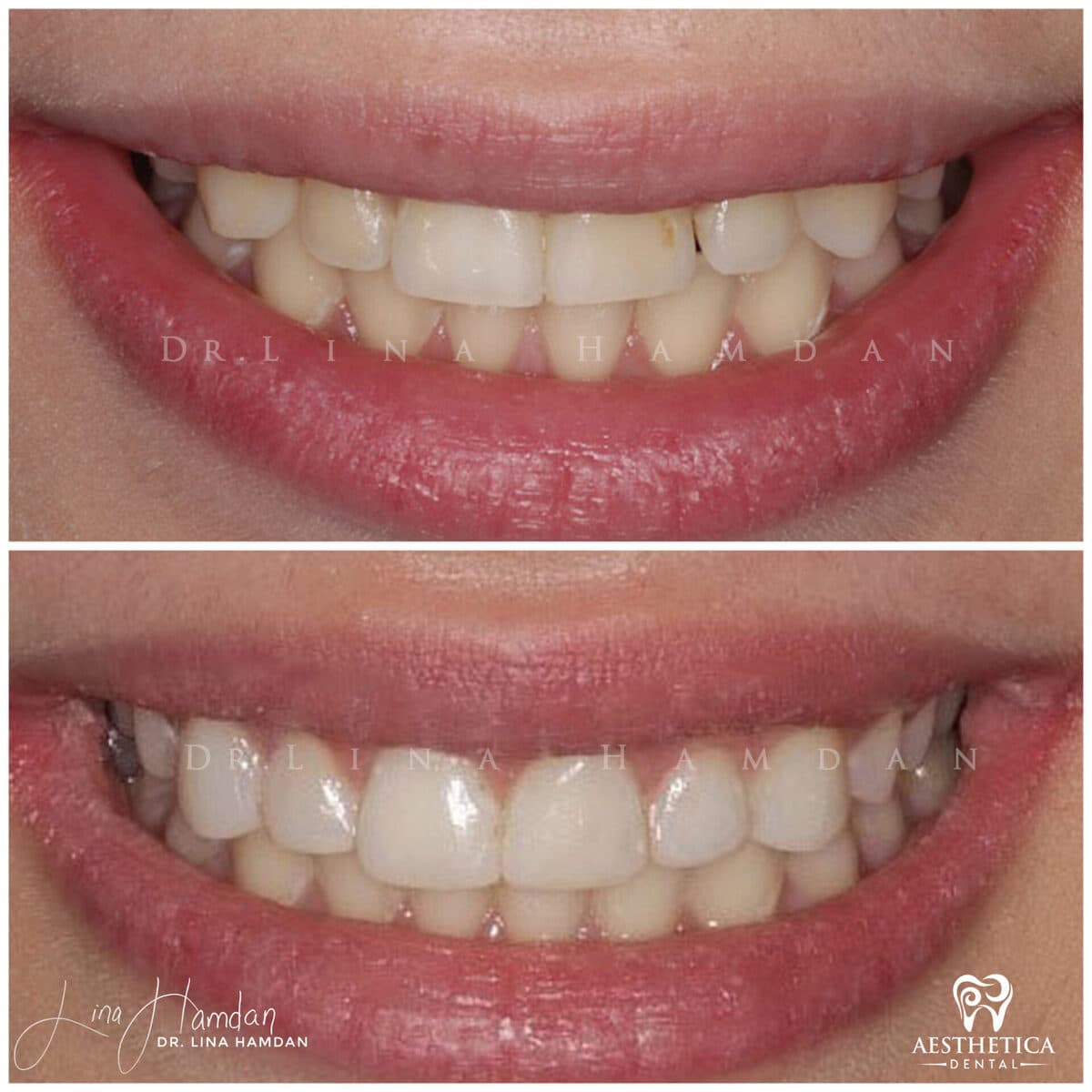 Composite bonding: anonymous case 96 from Aesthetica Dental Naperville