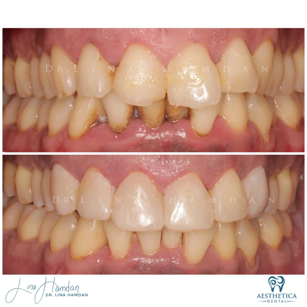Composite bonding: anonymous case 103 from Aesthetica Dental Naperville
