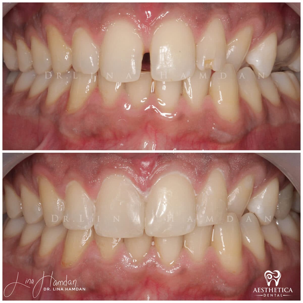 Composite bonding: anonymous case 104 from Aesthetica Dental Naperville