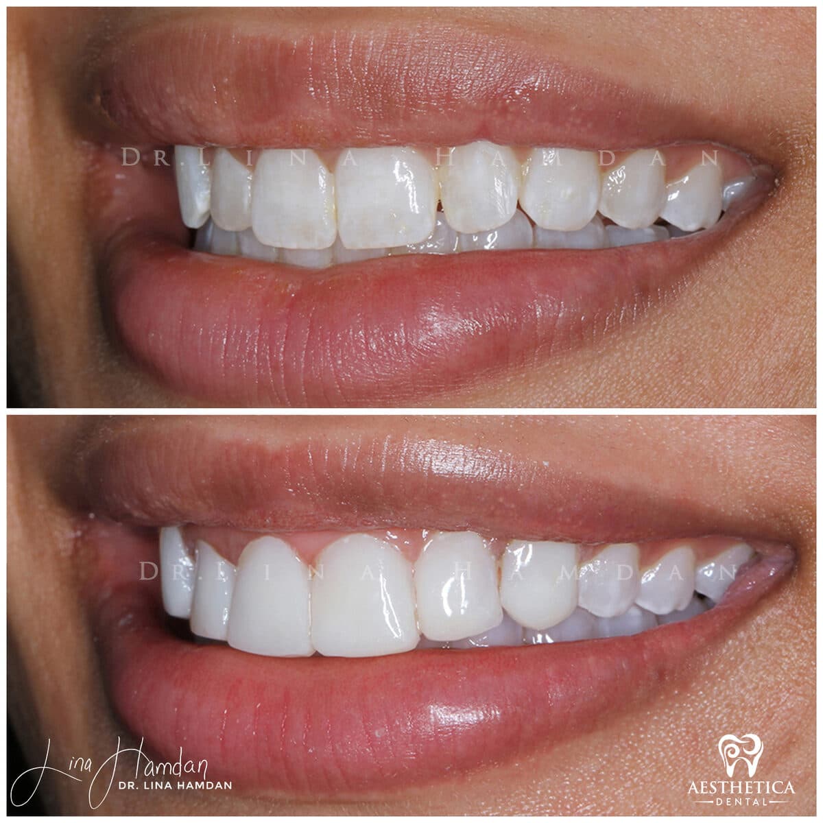 Composite bonding: anonymous case 107 from Aesthetica Dental Naperville