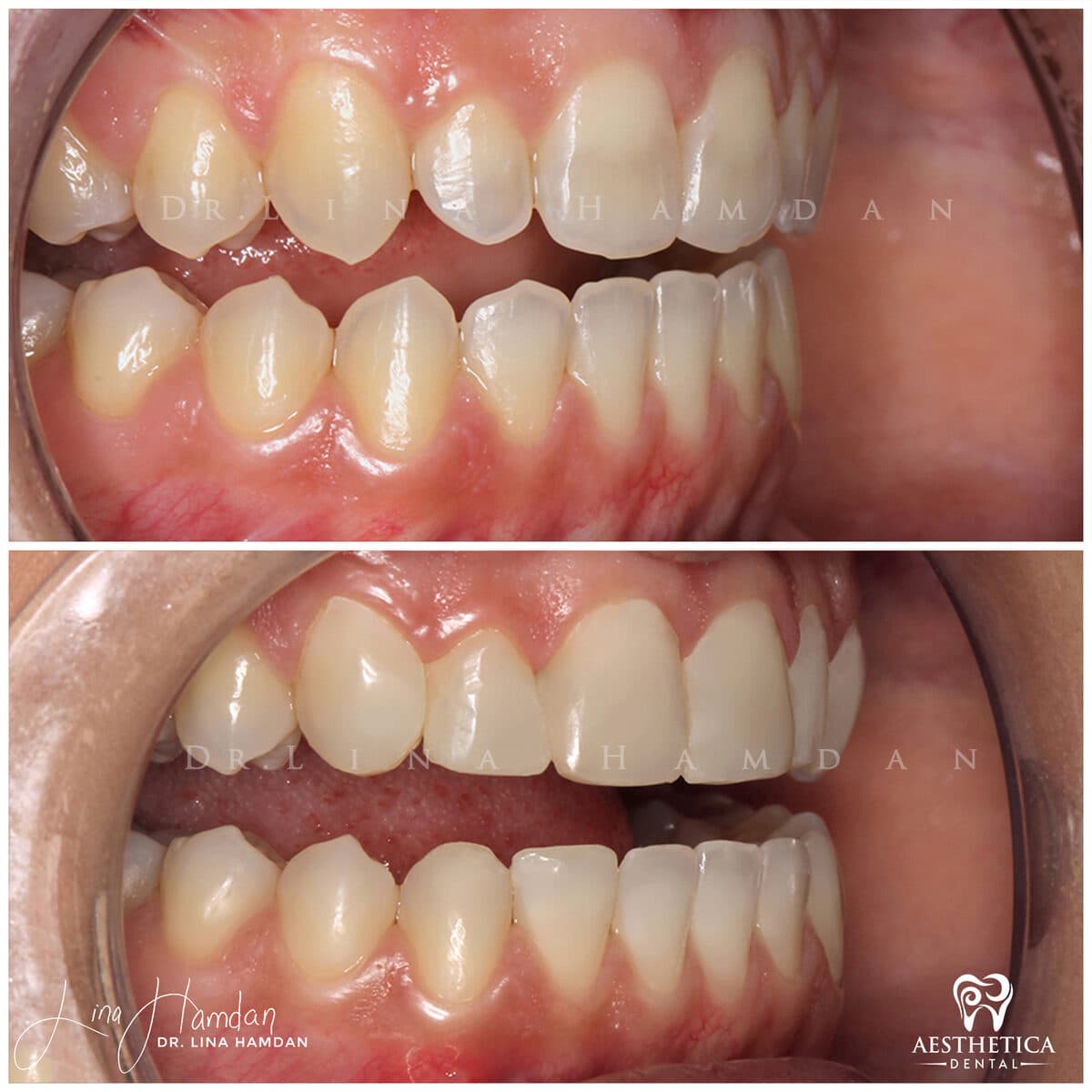Composite bonding: anonymous case 108 from Aesthetica Dental Naperville