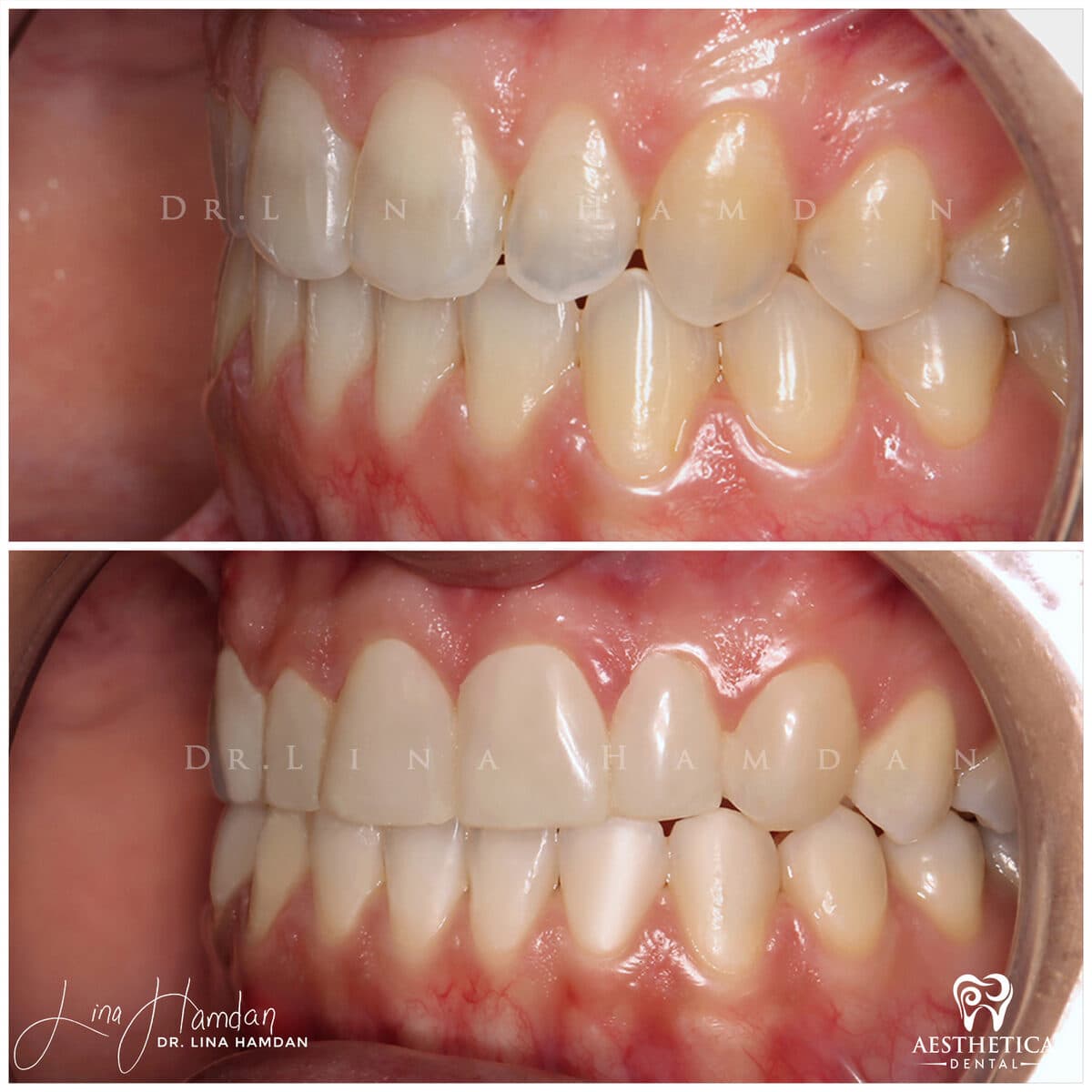 Composite bonding: anonymous case 109 from Aesthetica Dental Naperville
