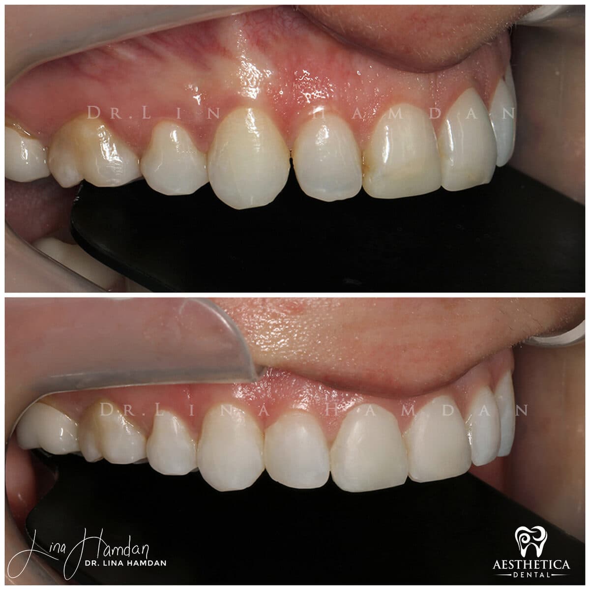 Composite bonding: anonymous case 111 from Aesthetica Dental Naperville