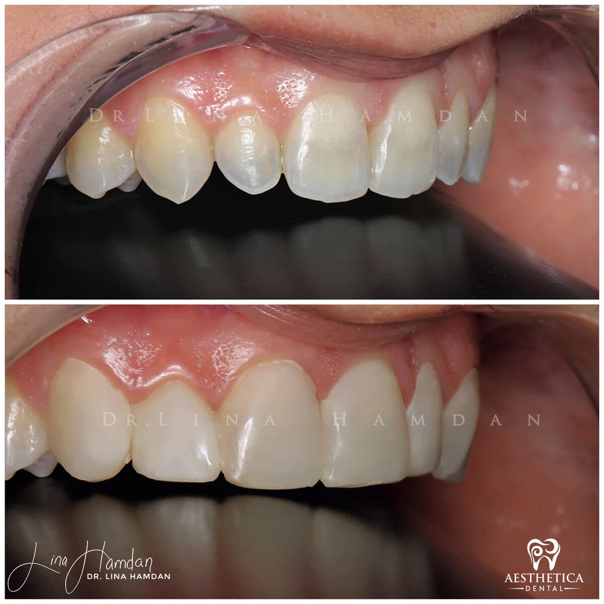 Composite bonding: anonymous case 114 from Aesthetica Dental Naperville