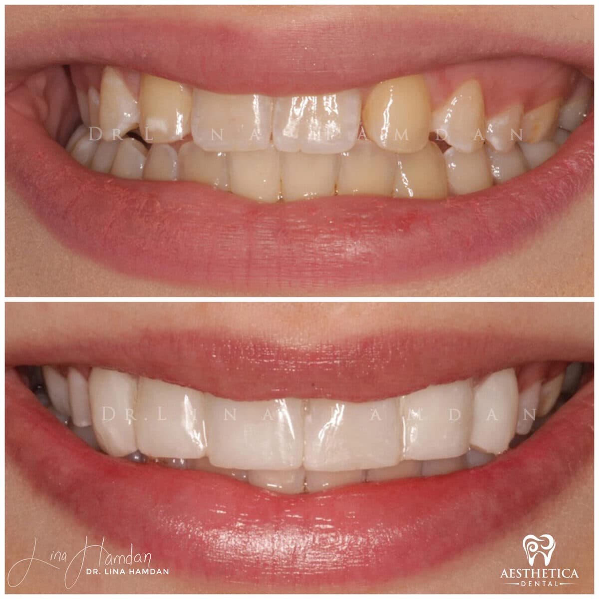 Composite bonding: anonymous case 118 from Aesthetica Dental Naperville