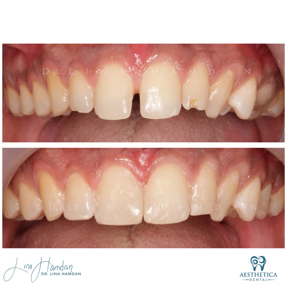 Composite bonding: anonymous case 119 from Aesthetica Dental Naperville