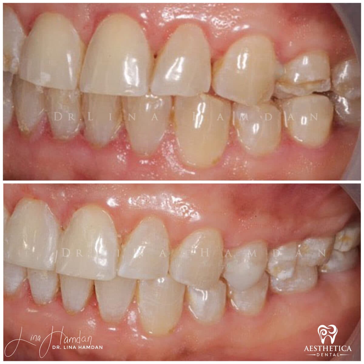 Composite bonding: anonymous case 120 from Aesthetica Dental Naperville