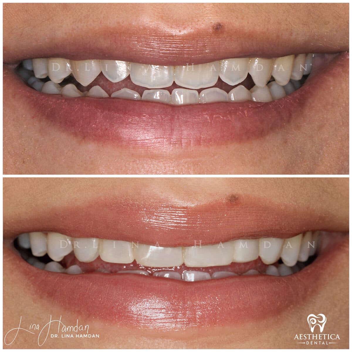 Composite bonding: anonymous case 123 from Aesthetica Dental Naperville