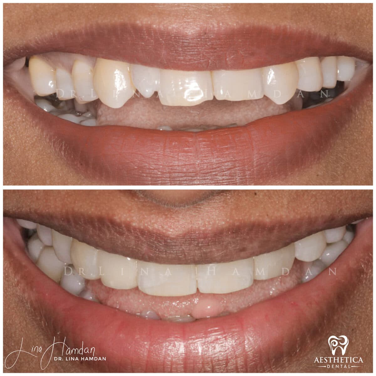 Composite bonding: anonymous case 127 from Aesthetica Dental Naperville