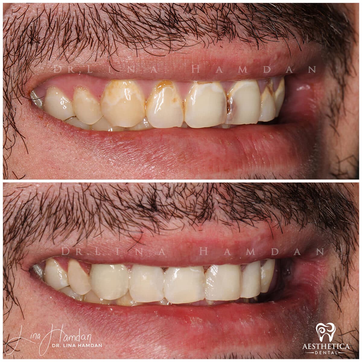 Composite bonding: anonymous case 133 from Aesthetica Dental Naperville