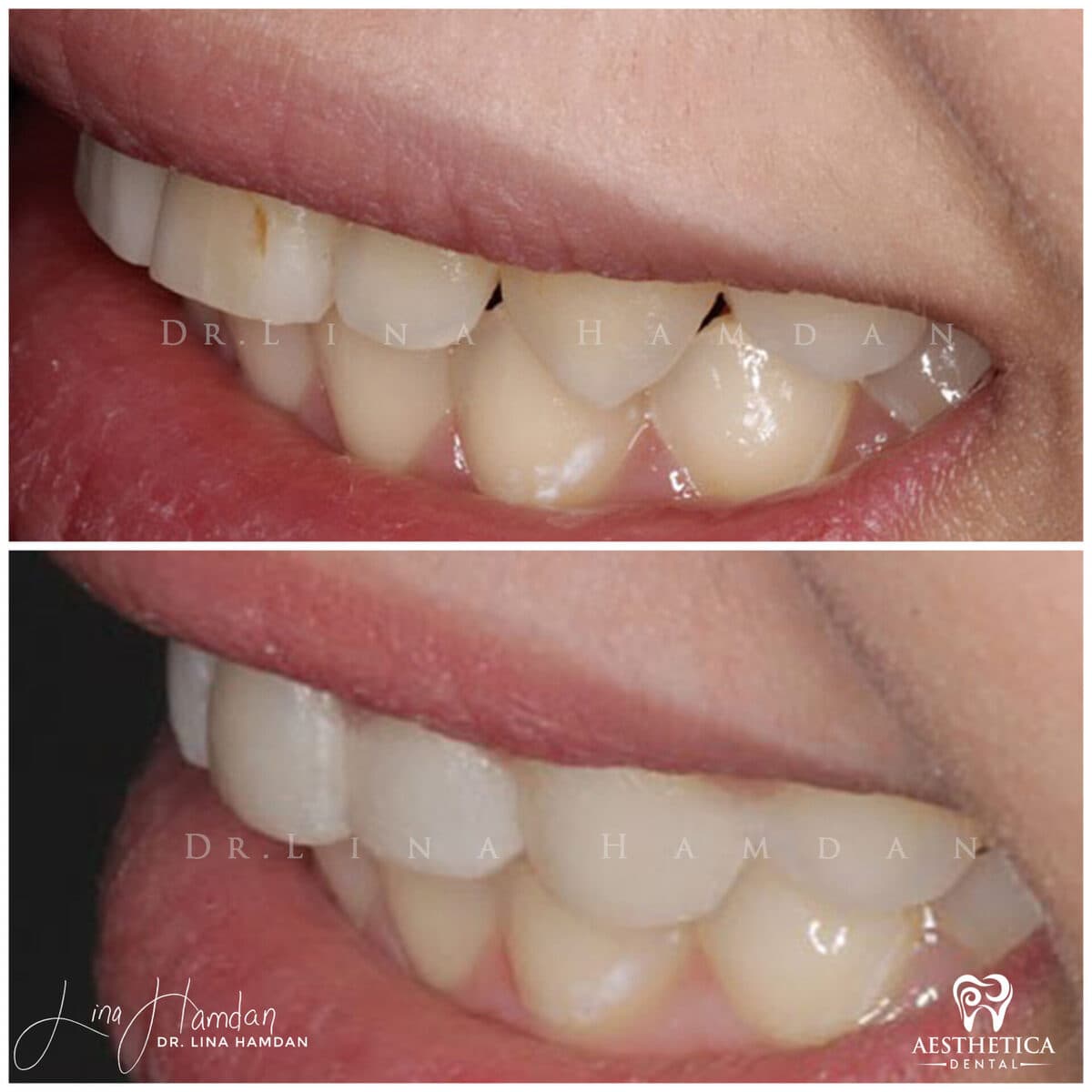 Composite bonding: anonymous case 136 from Aesthetica Dental Naperville