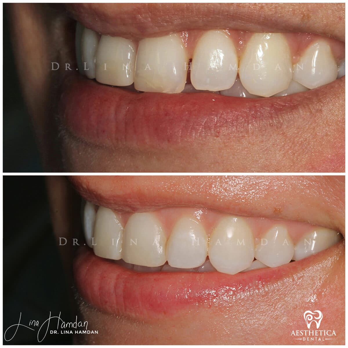 Composite bonding: anonymous case 138 from Aesthetica Dental Naperville