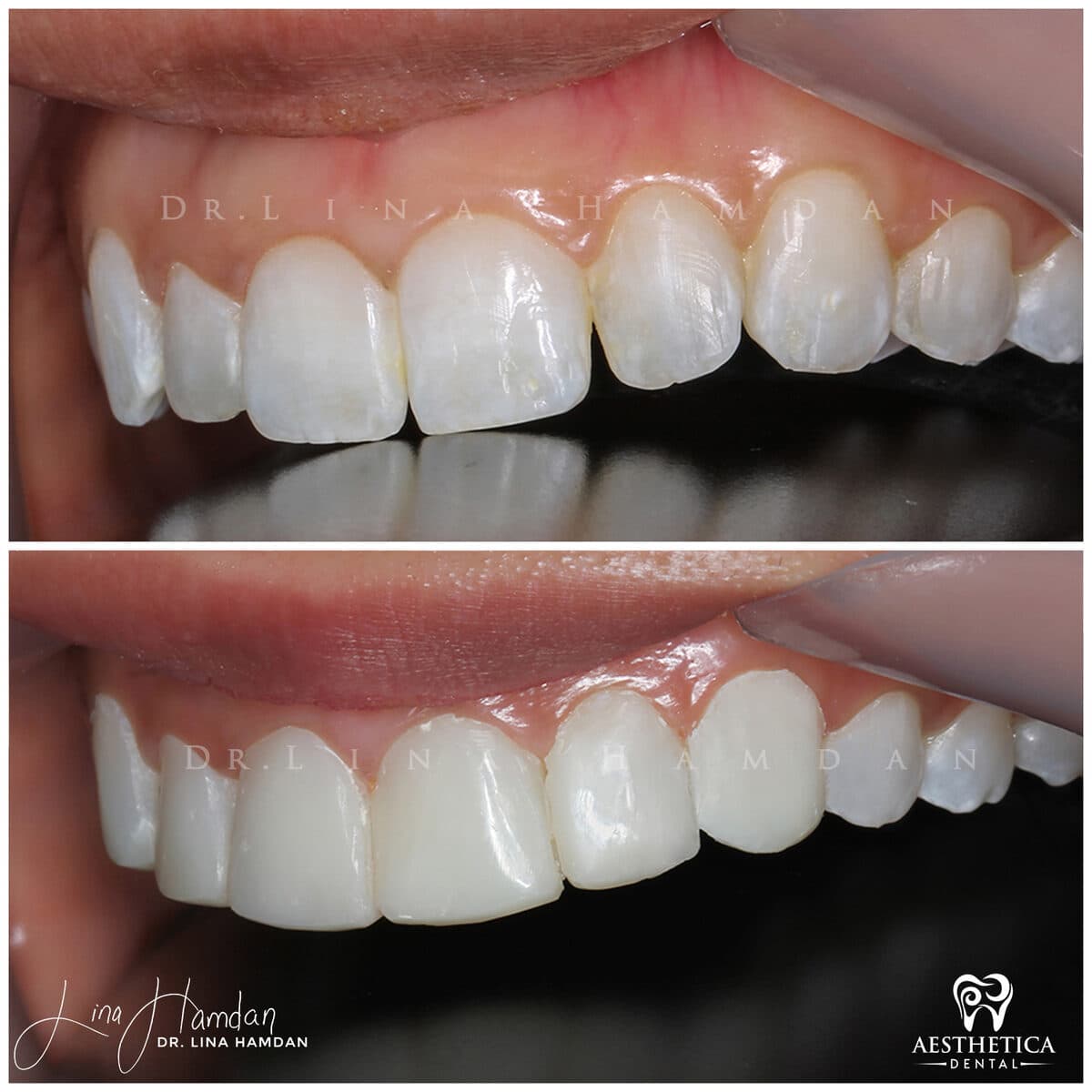 Composite bonding: anonymous case 139 from Aesthetica Dental Naperville