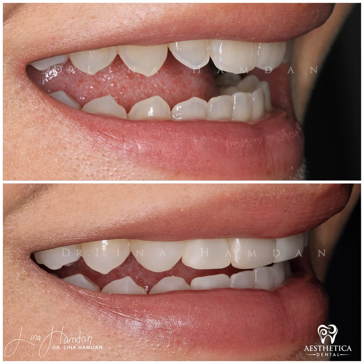 Composite bonding: anonymous case 140 from Aesthetica Dental Naperville
