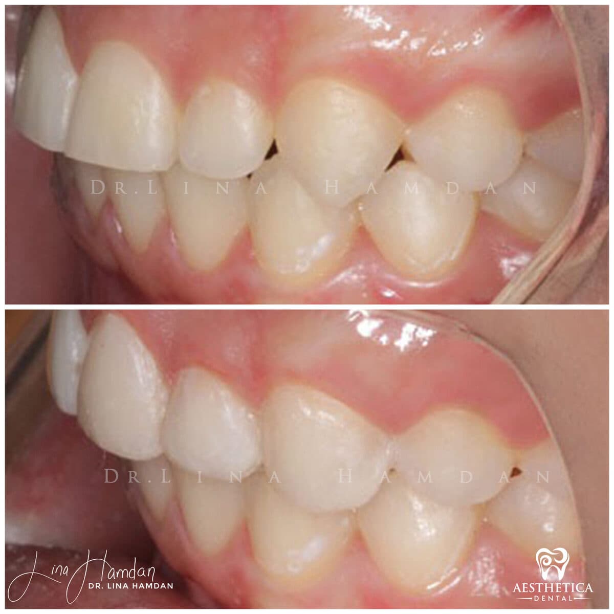 Composite bonding: anonymous case 150 from Aesthetica Dental Naperville