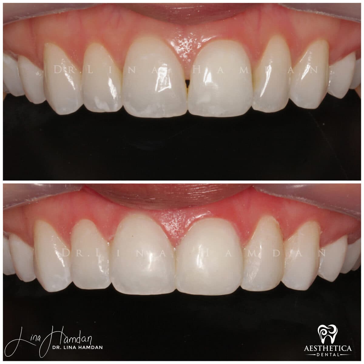 Composite bonding: anonymous case 151 from Aesthetica Dental Naperville
