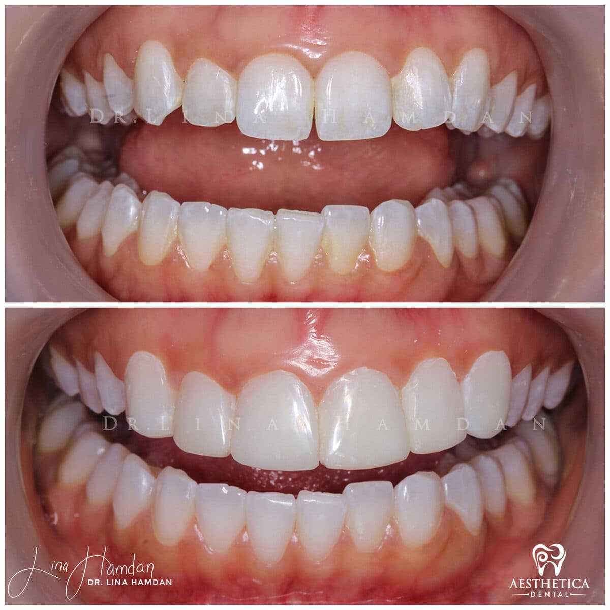 Composite bonding: anonymous case 154 from Aesthetica Dental Naperville