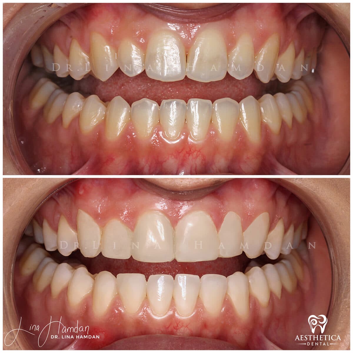 Composite bonding: anonymous case 155 from Aesthetica Dental Naperville