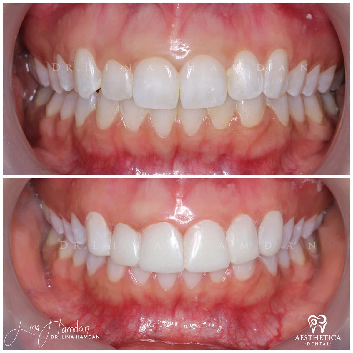 Composite bonding: anonymous case 158 from Aesthetica Dental Naperville