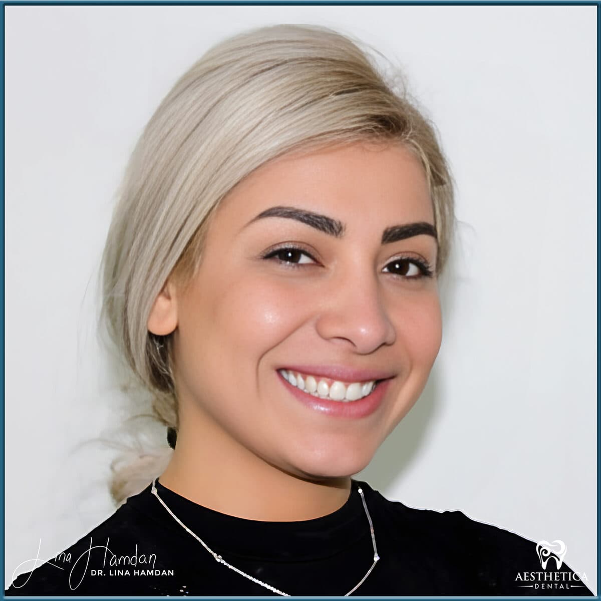 Composite bonding: anonymous case 159 from Aesthetica Dental Naperville
