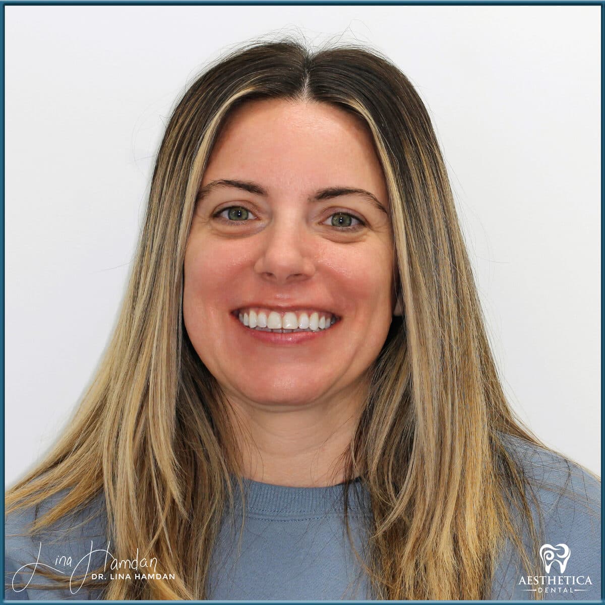 Composite bonding: anonymous case 168 from Aesthetica Dental Naperville